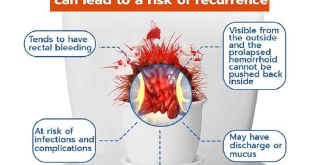 How Do U Stop Hemorrhoids from Bleeding?