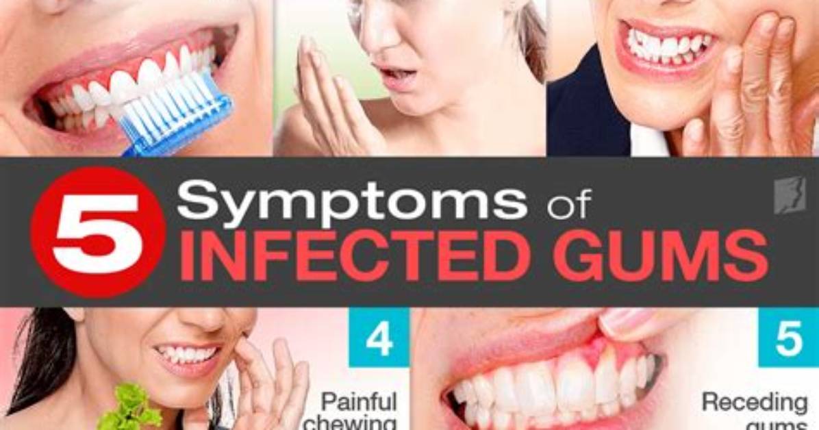 How Do You Clean Infected Gums?