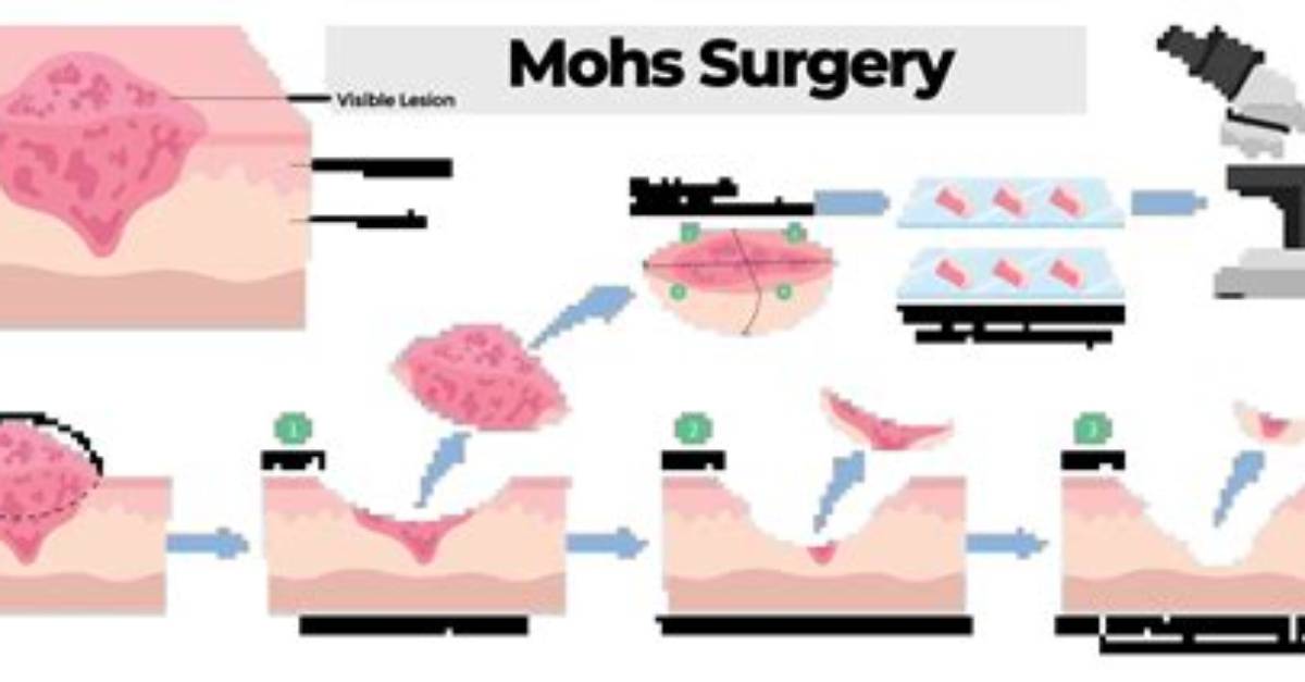 How Do You Code Mohs