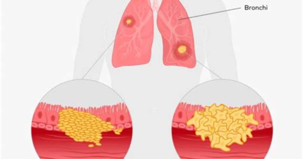 How Do You Code Non Small Cell Lung Cancer