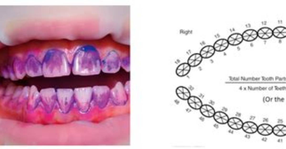 How Do You Compute for Plaque Index per Tooth