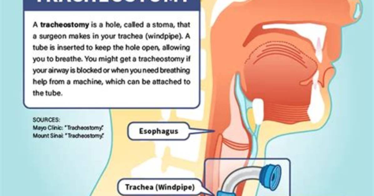 How Do You Confirm a Tracheostomy Placement