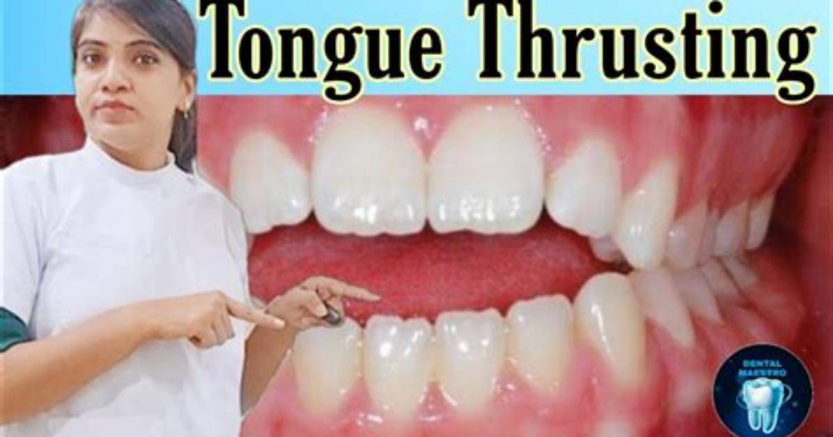 How Do You Control Tongue Thrust While Sleeping?
