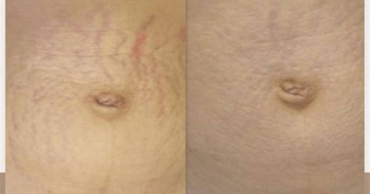 How Do You Cover up Stretch Marks with Makeup?