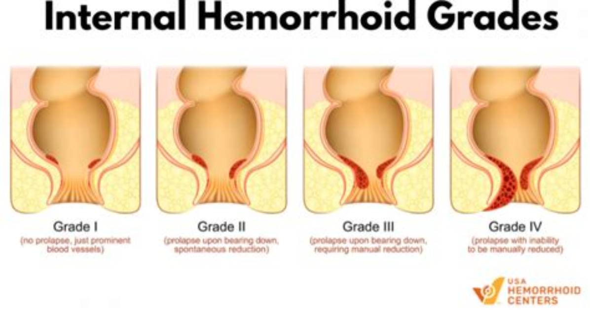 How Do You Detect Internal Hemorrhoids?