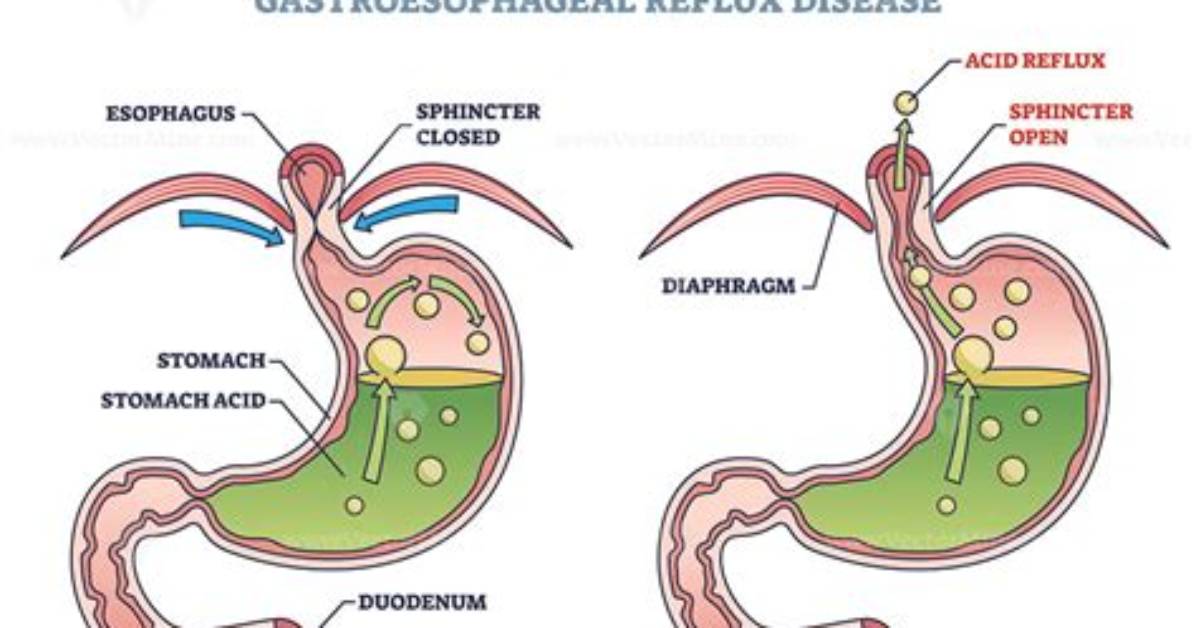 How Do You Explain Gerd to a Patient