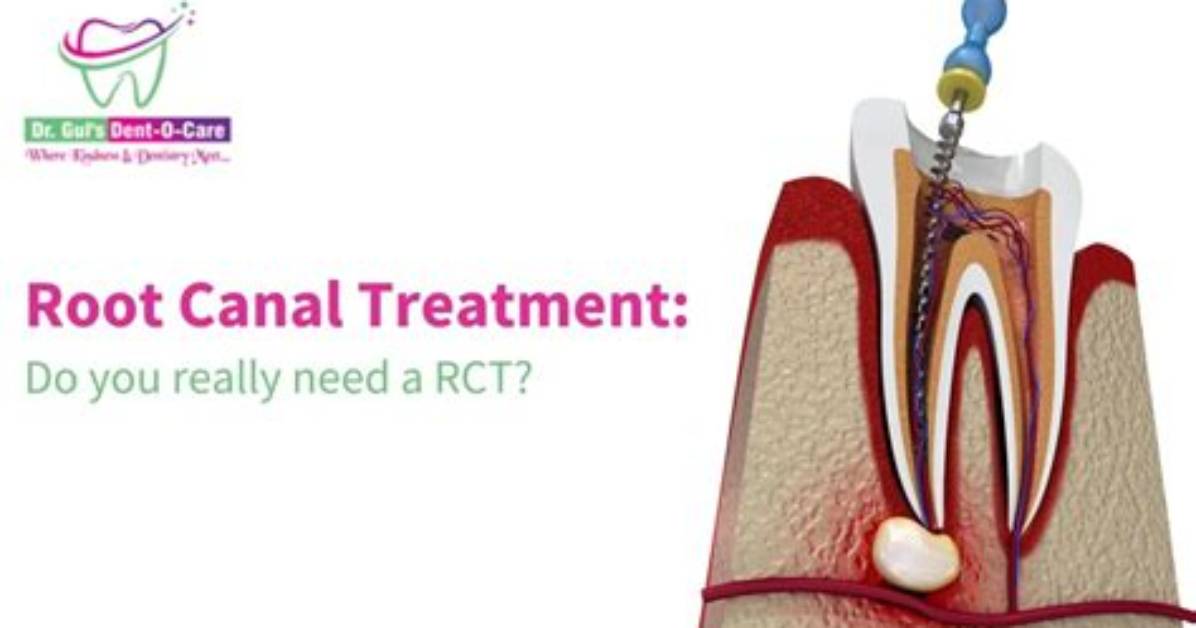 How Do You Explain Rct