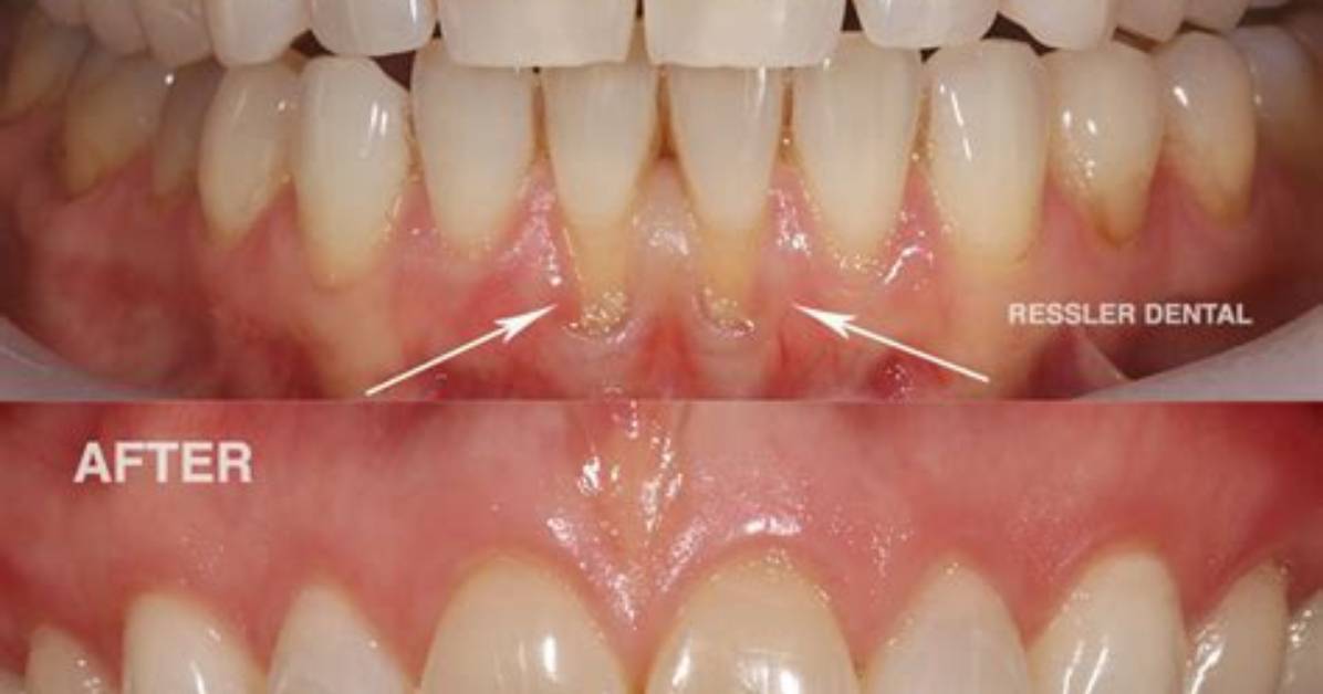 How Do You Fix Receding Gums?