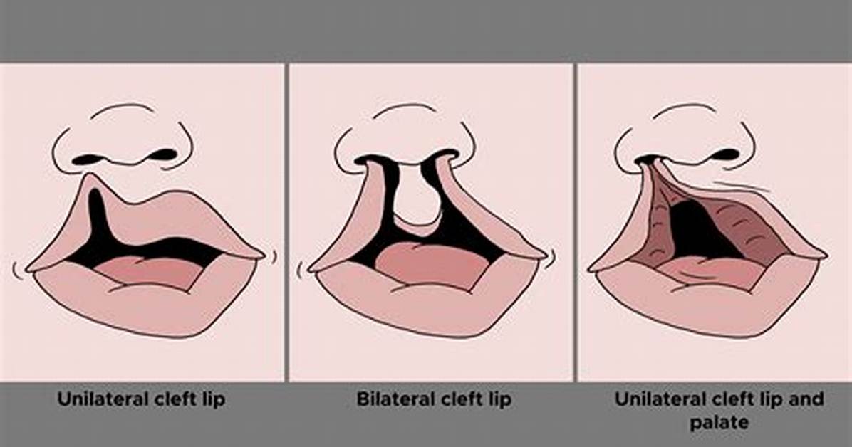 How Do You Get a Harelip?