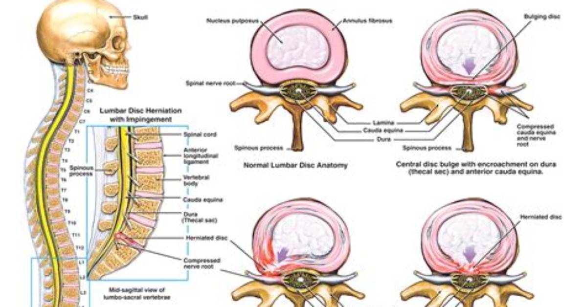 How Do You Get a Herniated Disc