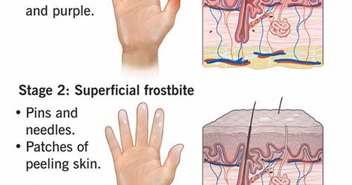 How Do You Get Frostbite?