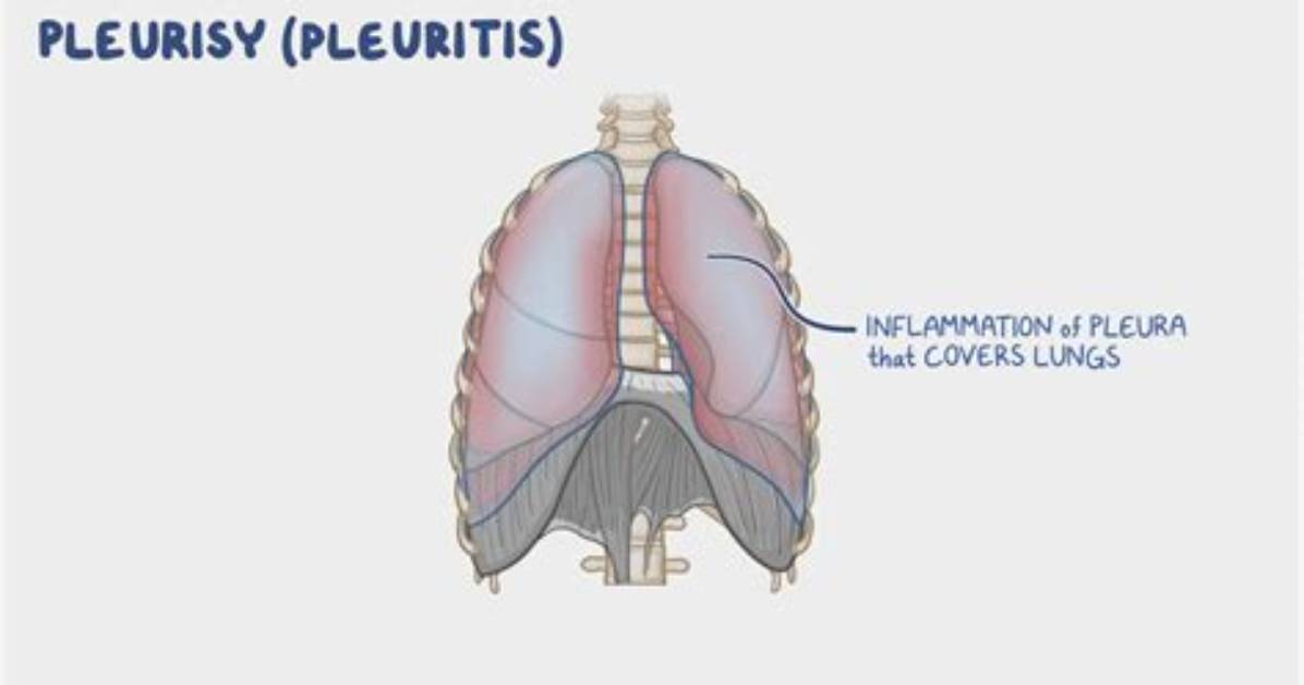 How Do You Get Pleurisy?