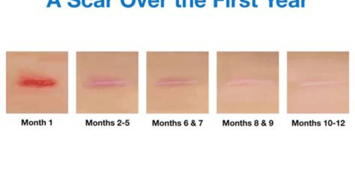 How Do You Get Scars