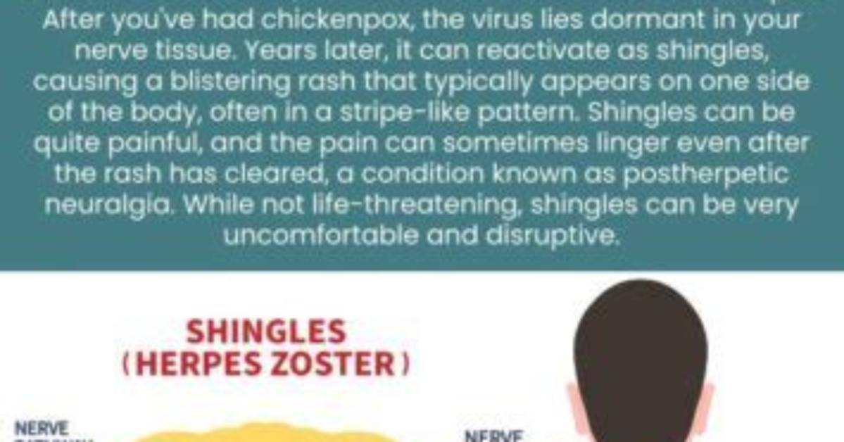 How Do You Get Shingles?