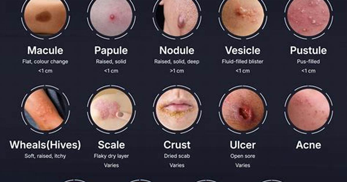 How Do You Heal Macules