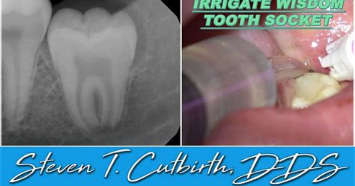 How Do You Irrigate Wisdom Teeth Sockets?