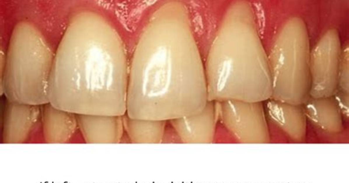 How Do You Know If Gingivitis Is Getting Worse?