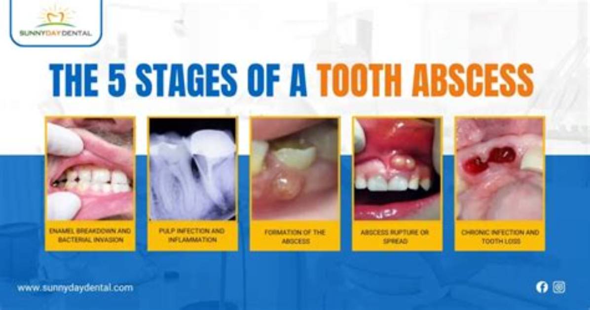 How Do You Know When an Abscess Is Completely Drained