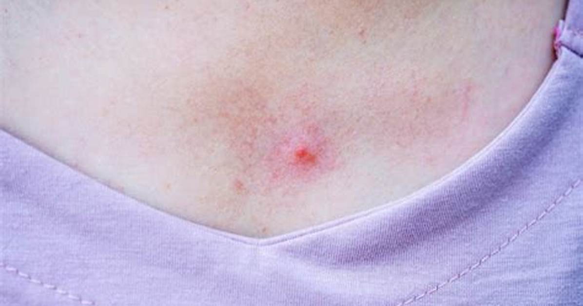 How Do You Prevent Sweat Pimples?