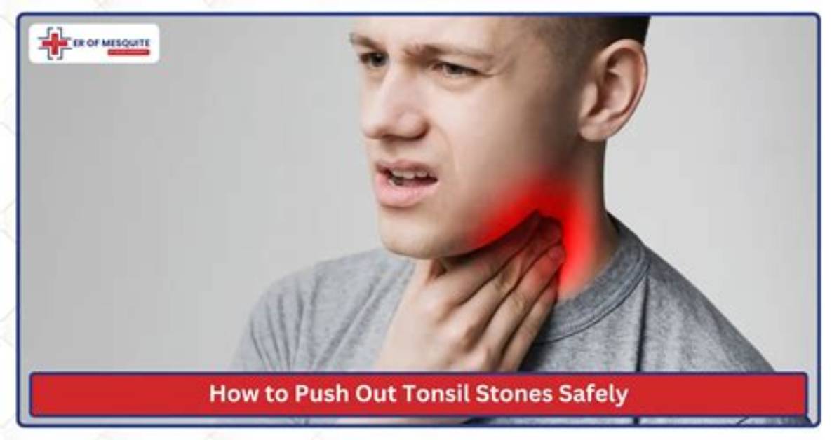 How Do You Push out a Tonsil Stone?
