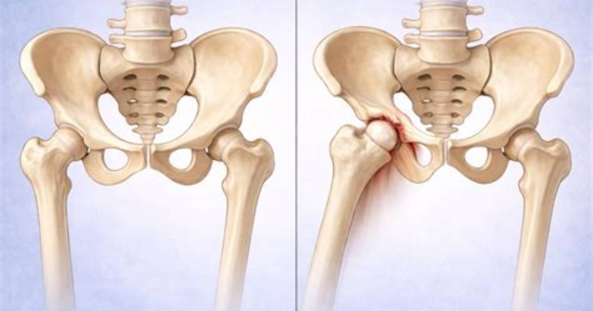 How Do You Reduce Anterior Hip Dislocation