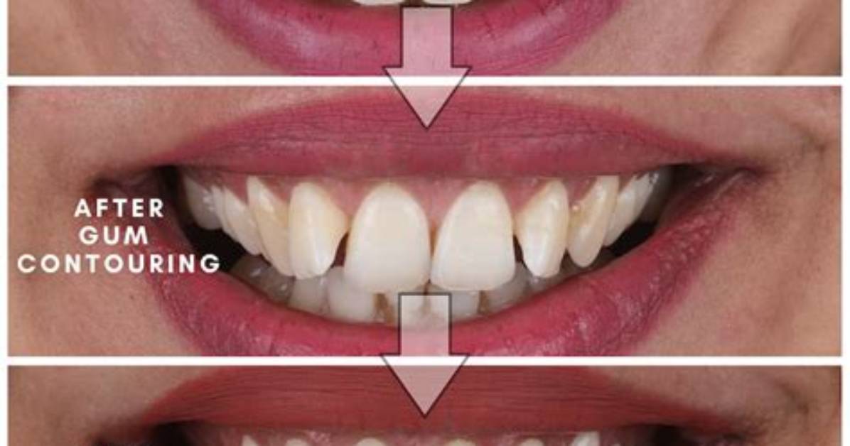 How Do You Remove Gum That Has Been Washed and Dried?