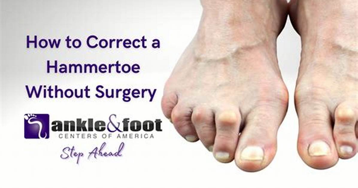 How Do You Straighten a Hammer Toe?
