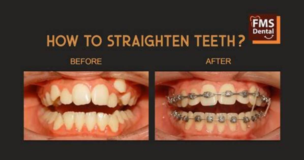 How Do You Straighten Teeth?