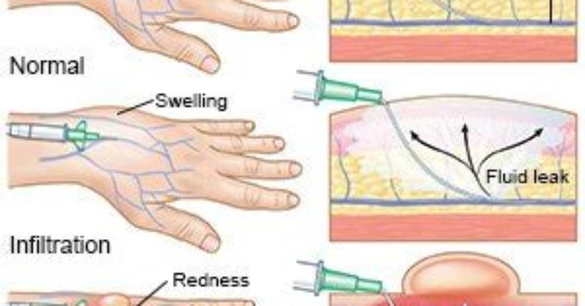How Do You Test for Iv Infiltration