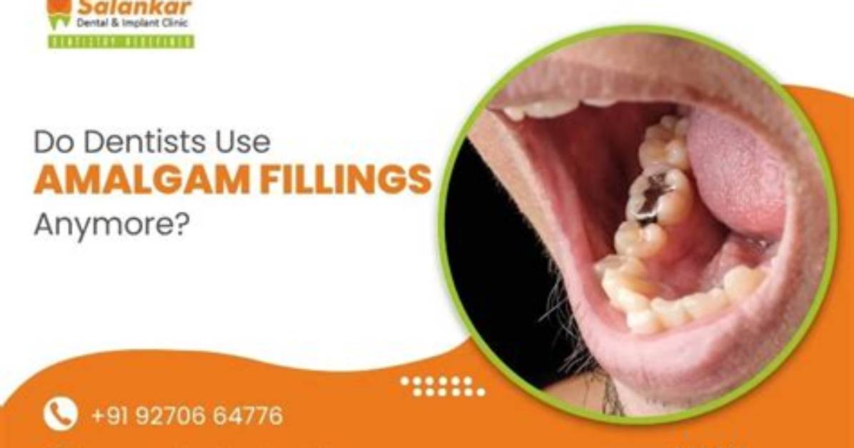 How Do You Use Amalgam