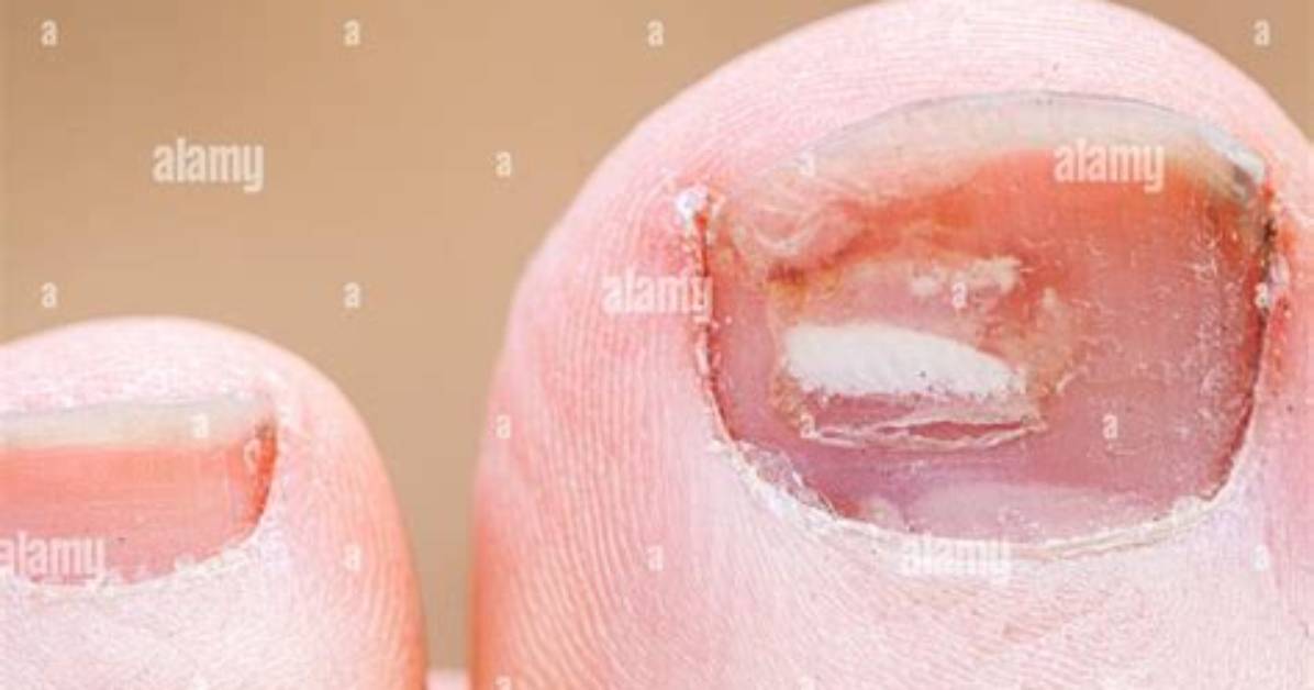 How Does a Toenail Grow