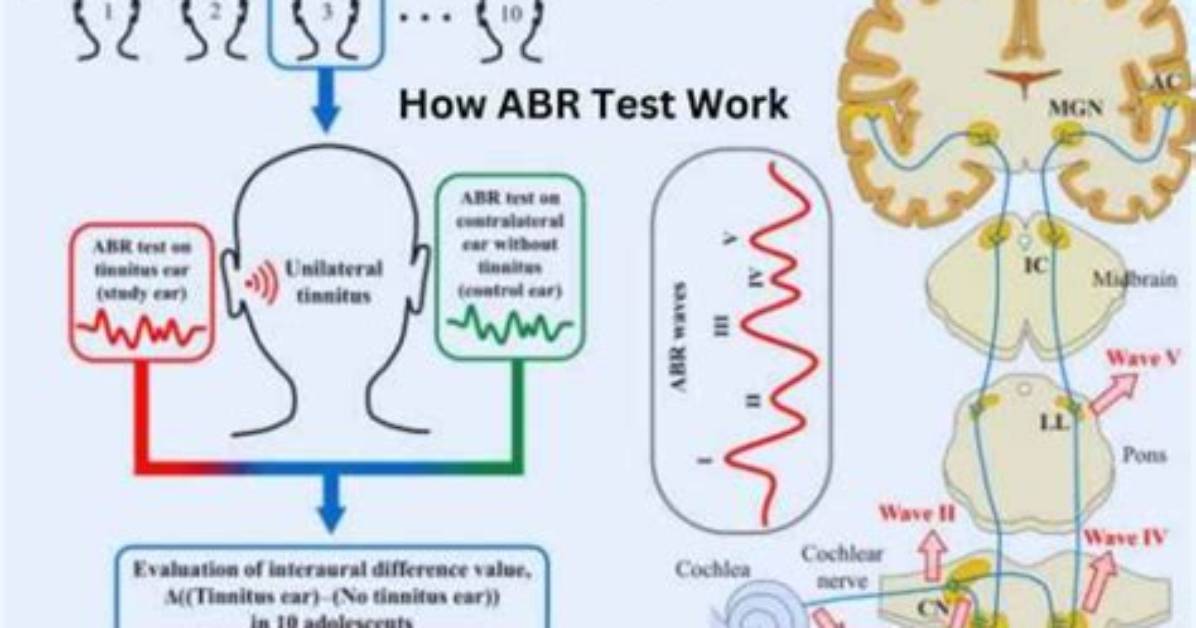 How Does Abr Test Work