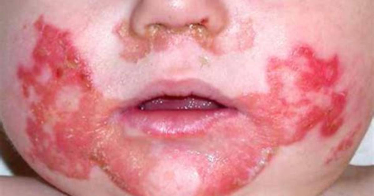 How Does Acrodermatitis Affect the Skin?