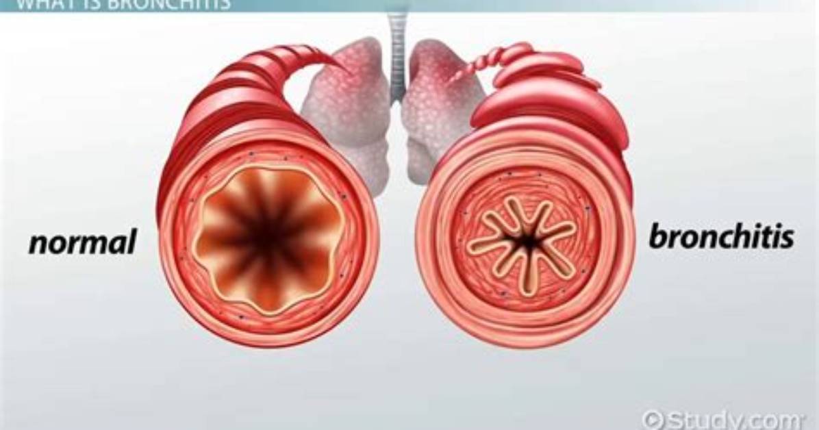 How Does Bronchitis Present