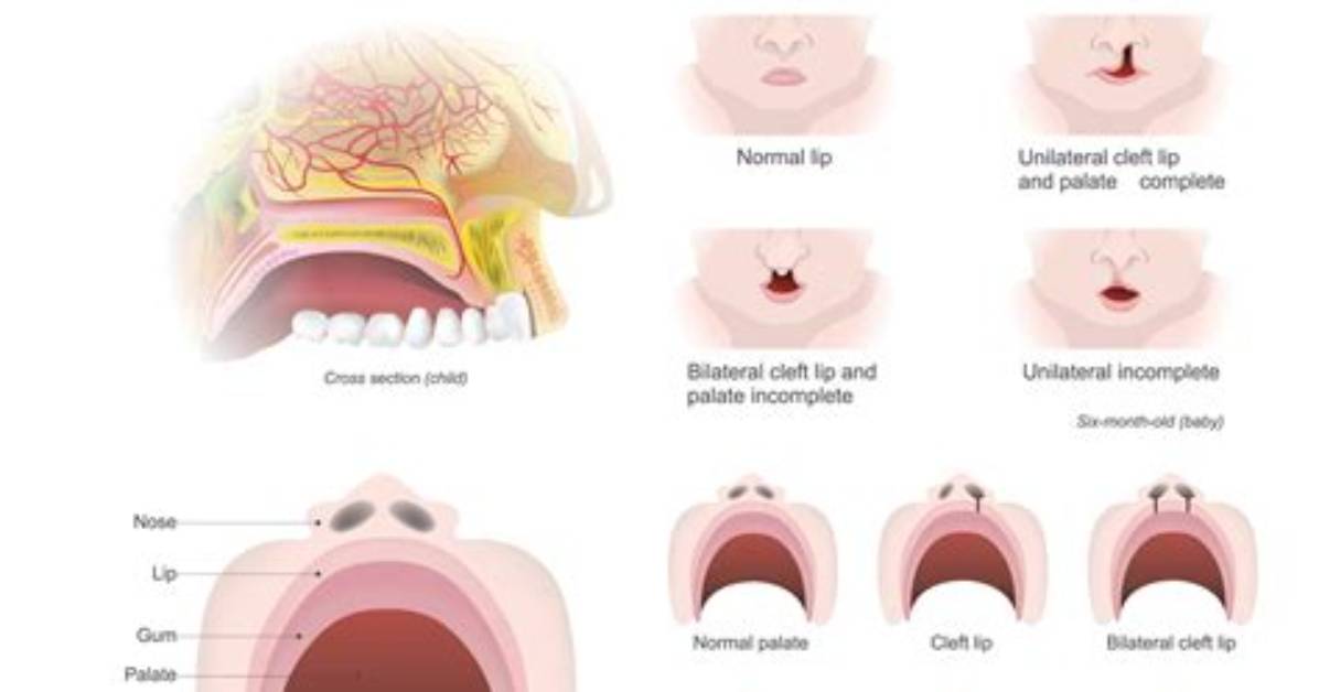 How Does Cleft Palate Affect Speech