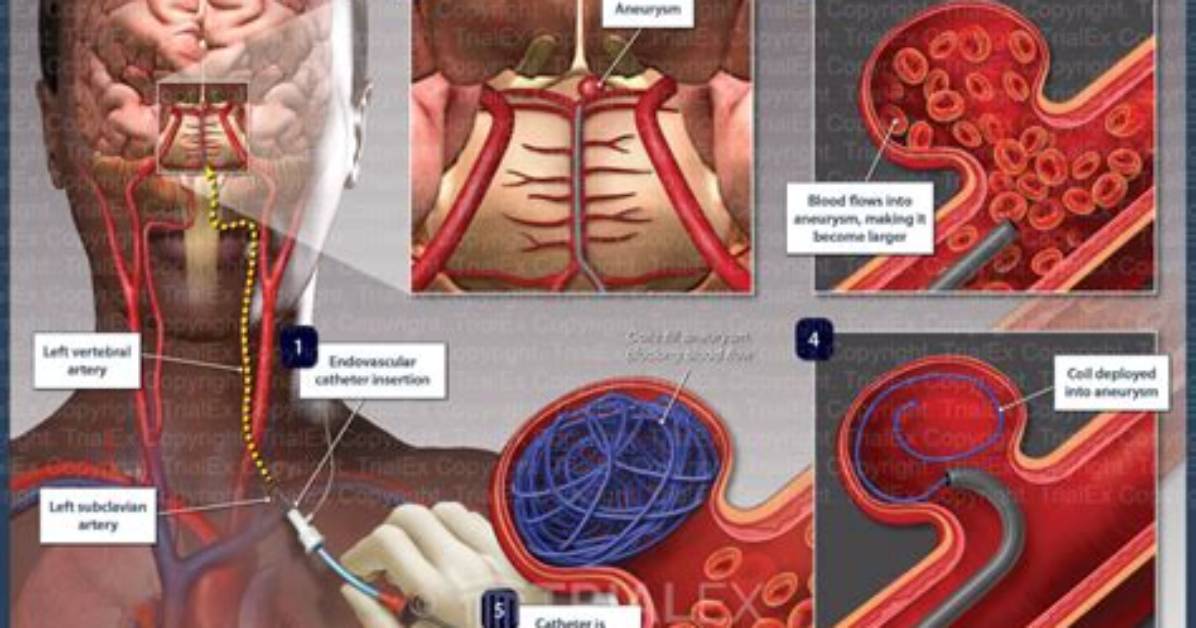How Does Coil Embolization Work?