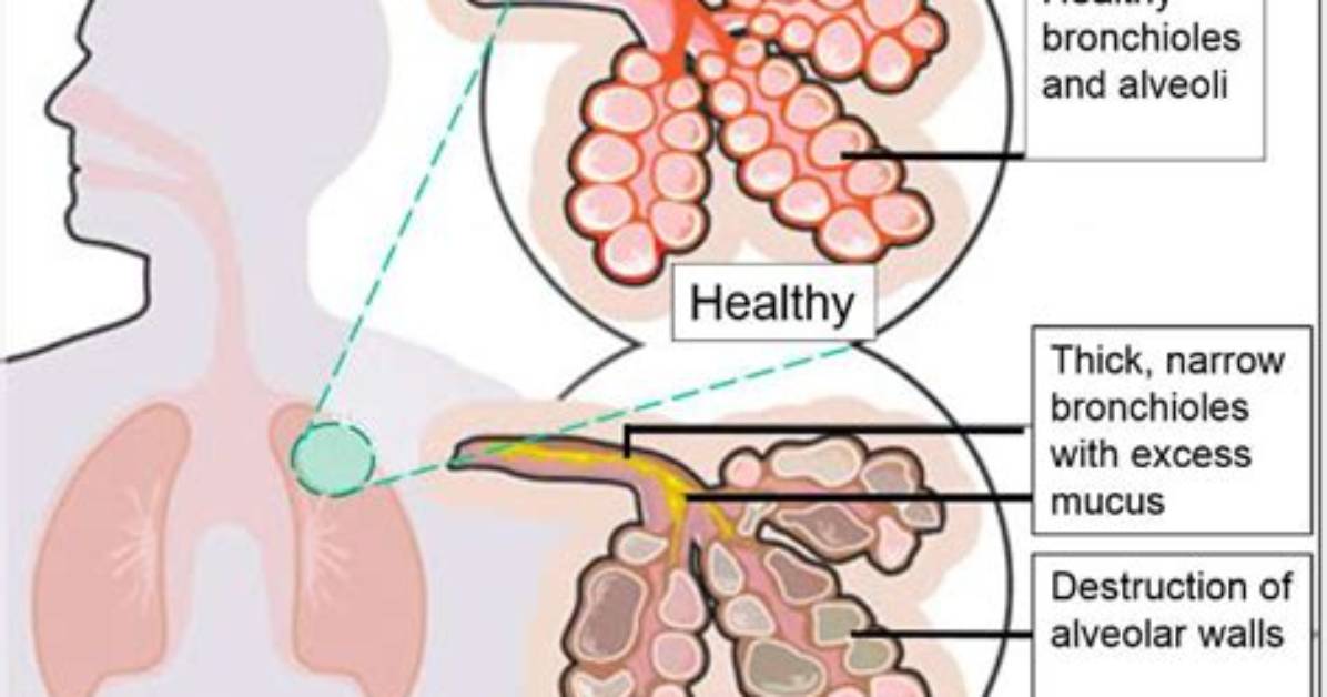 How Does Copd Affect Co2