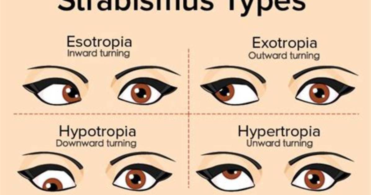 How Does Cross Eyed Affect Vision?