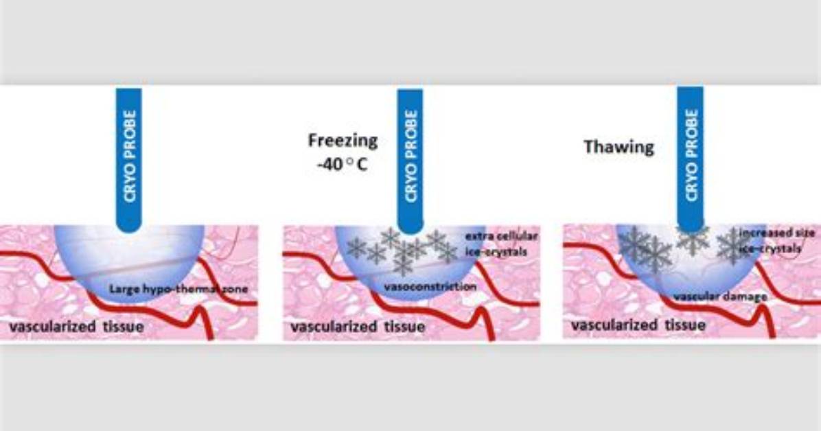 How Does Cryotherapy Work?