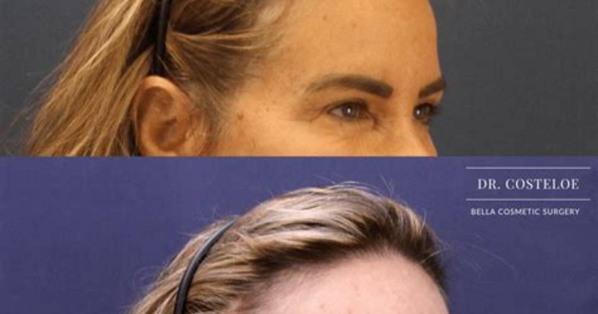 How Does Endoscopic Brow Lift Work?
