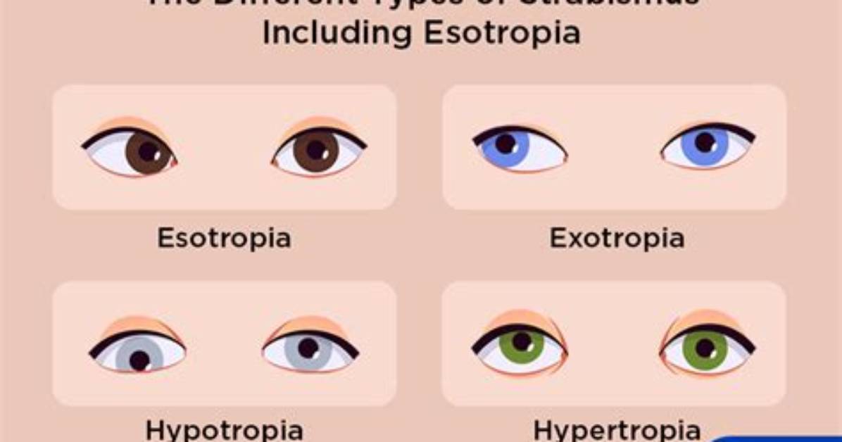 How Does Esotropia Affect Vision?