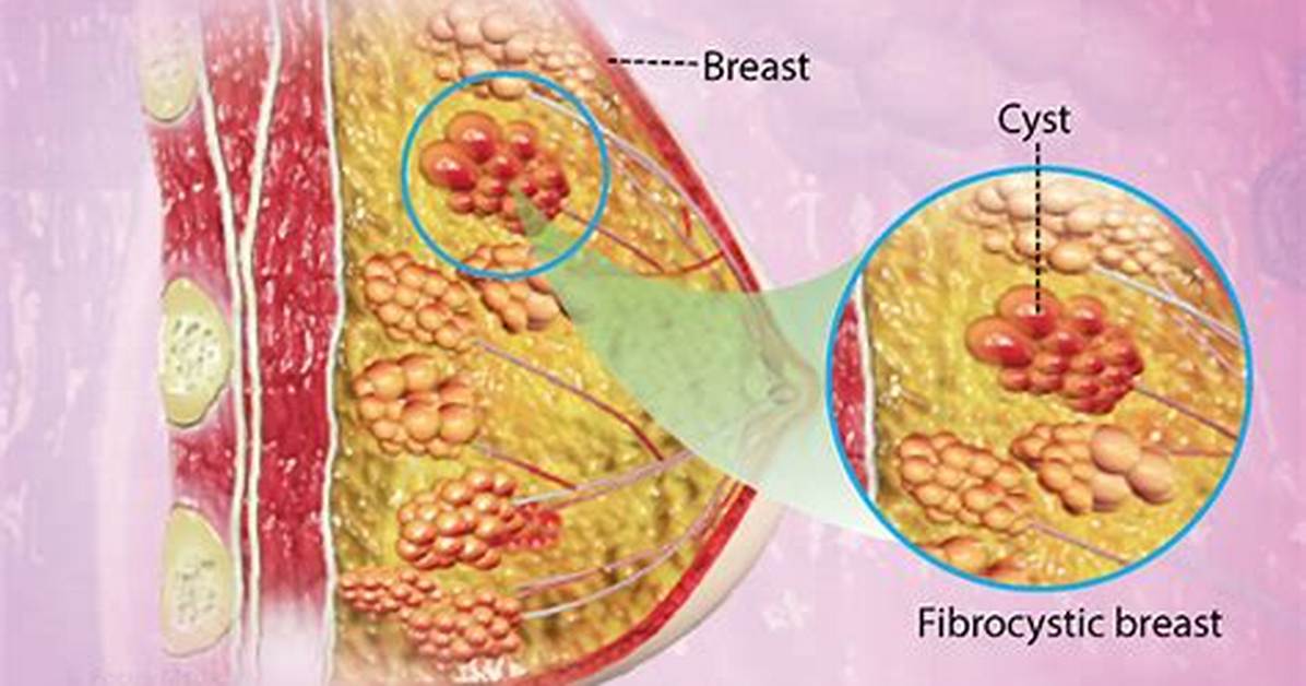 How Does Fibrocystic Breast Disease Develop?