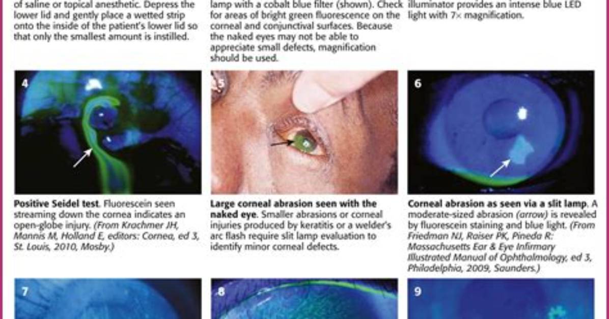 How Does Fluorescein Work in the Eye