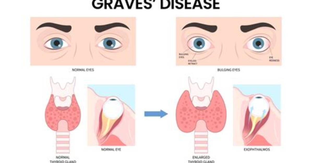 How Does Graves Disease Affect the Eyes