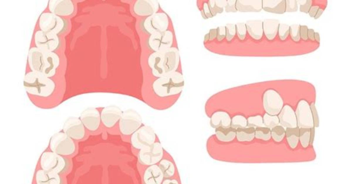 How Does Hyperdontia Happen?