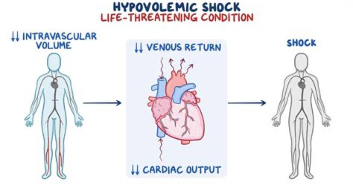 How Does Hypovolemic Shock Affect the Cardiovascular System
