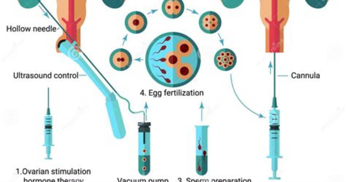 How Does in Vitro Fertilization Work Quizlet