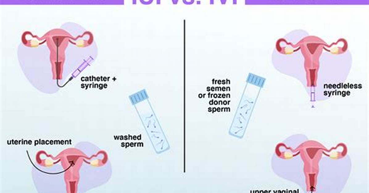 How Does Intracervical Insemination Work?