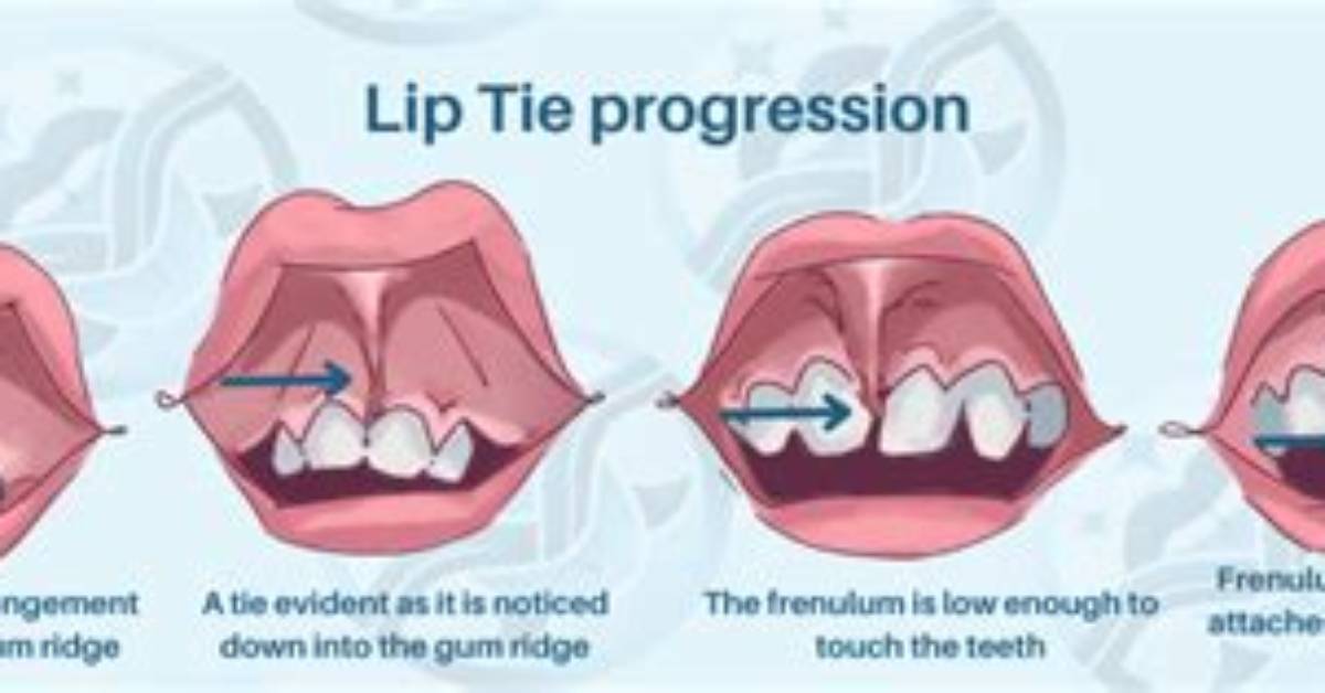 How Does Lip Tie Affect Teeth?