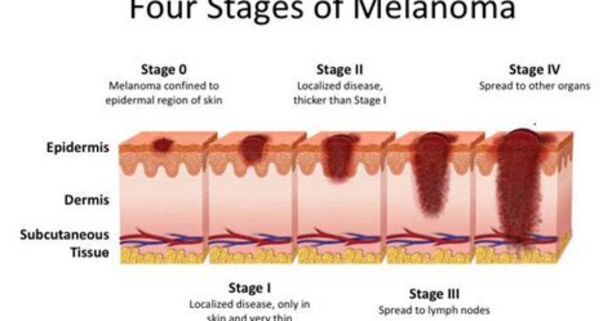 How Does Melanoma Spread?